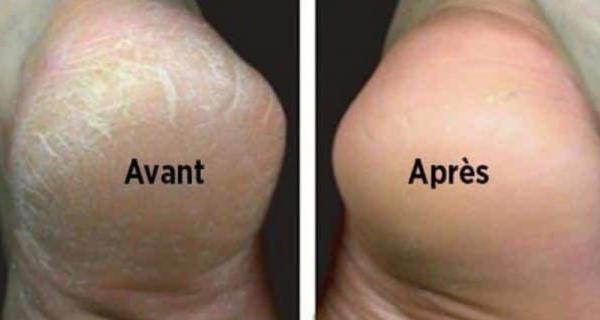 Pieds secs: Comment retrouver des beaux pieds tout doux comme les bébés.....