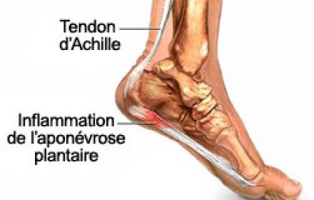 Douleur Au Niveau De La Voute Plantaire Ou Au Niveau Du Tendon D Achille Et Si C Etait Une